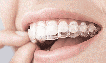 aligner