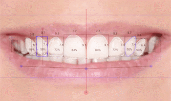 smile design