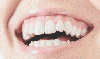 gummy smile